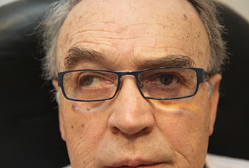 Estrabismo divergente del ojo derecho