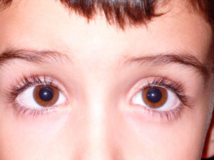 Test de Hirschberg para detectar el estrabismo