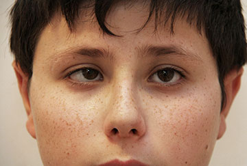 El estrabismo puede causar ambliopía