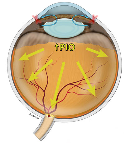 Efectos de la presión intraocular