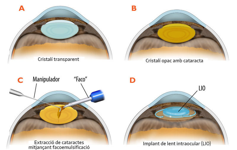 Esquema de la cataracta
