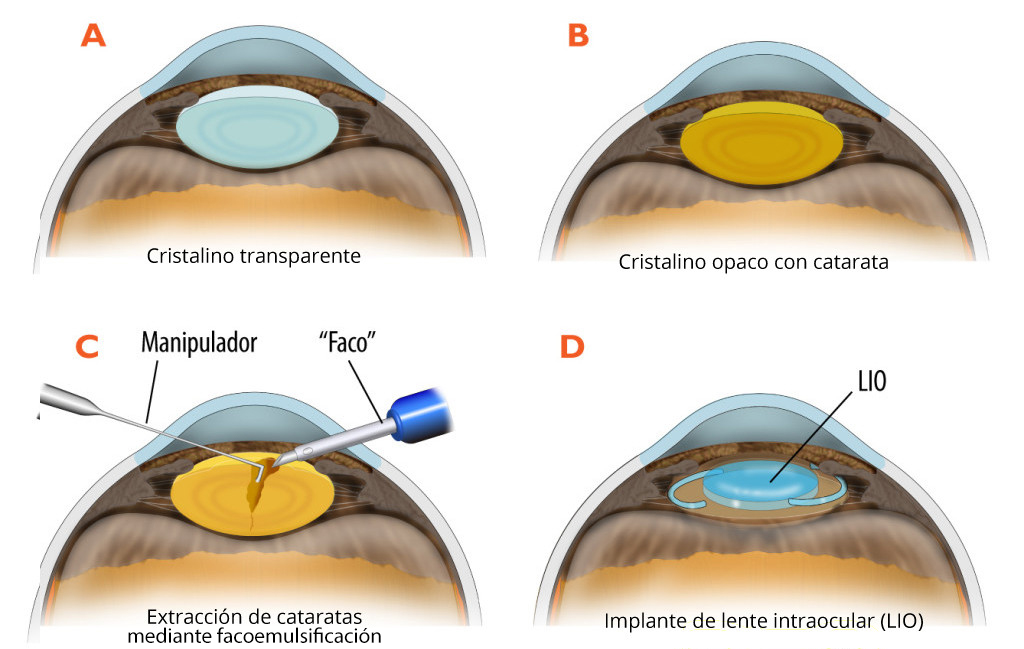 Cristalino opaco de la catarata