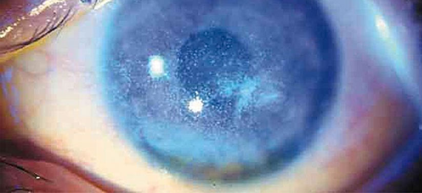 Prevenir la radiación ocular