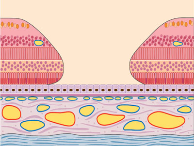 Agujero macular en la zona de la fóvea.
