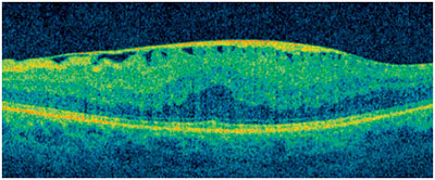 Proliferación fibrosa avascular sobre la retina.