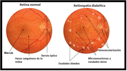 Retina normal y retina diabetica