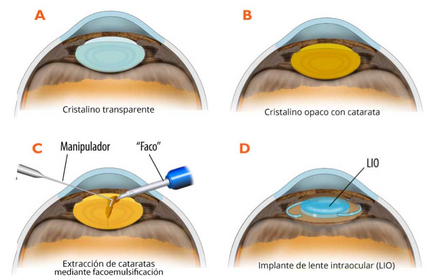 esquema-intervencion-cataratas