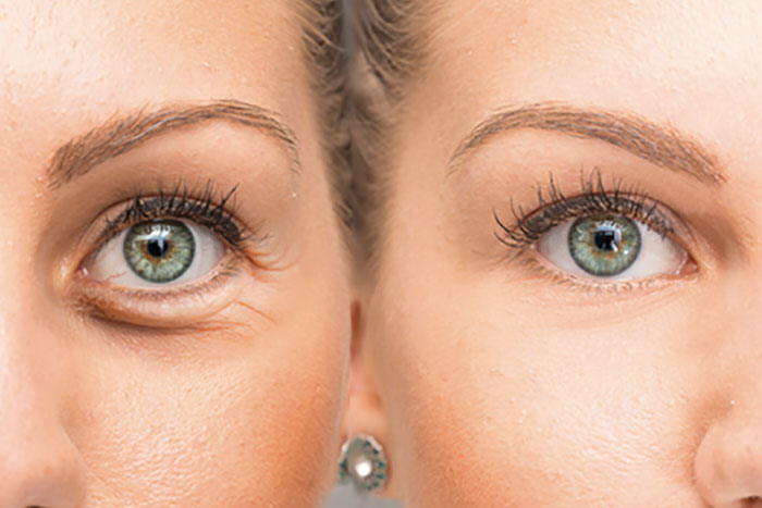 Tratamiento oculofacial - INOF