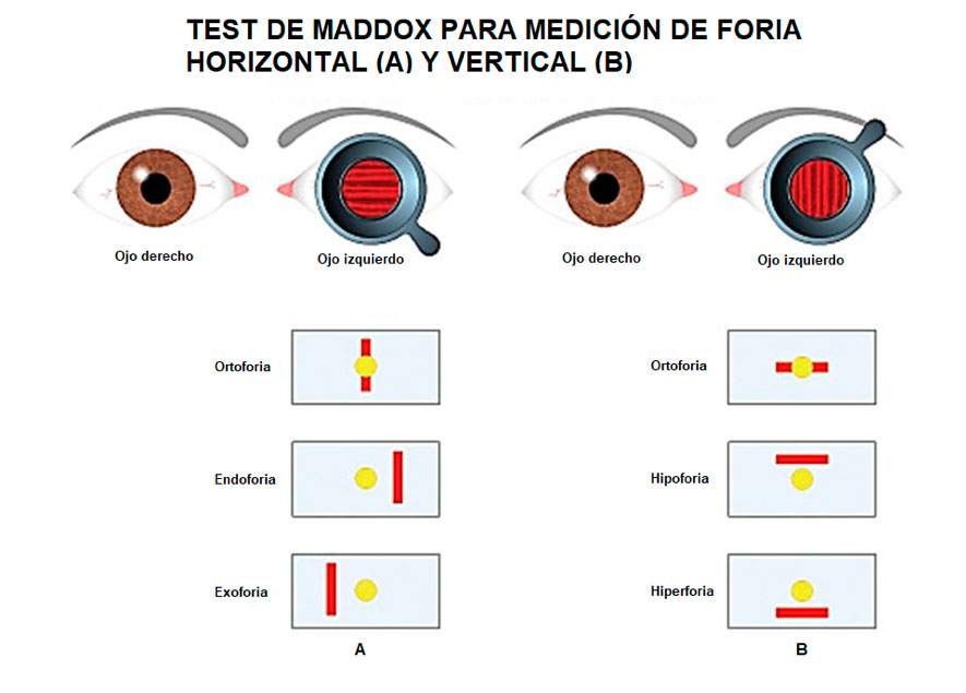 Esquema de un examen de Maddox y sus posibles respuestas
