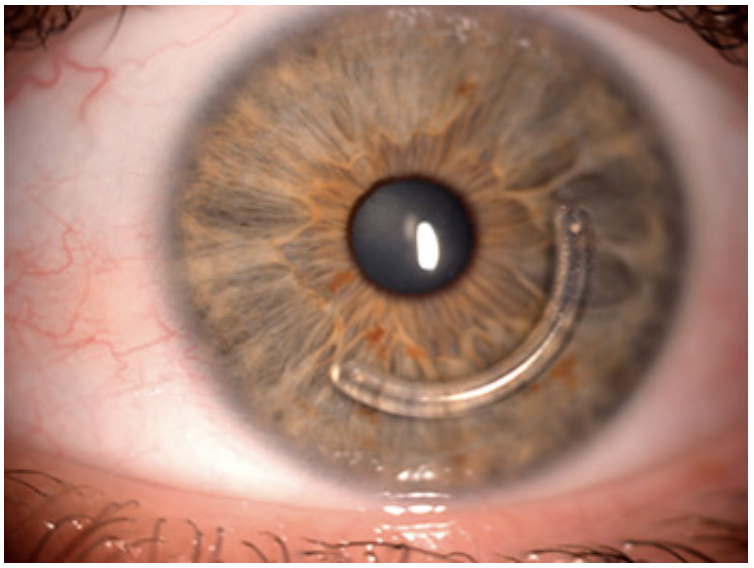Anillo intracorneal - Tratamientos queratocono -Inof