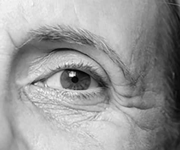 Tratamiento de ojeras -Inof