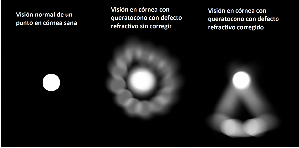 Visión de un paciente con queratocono