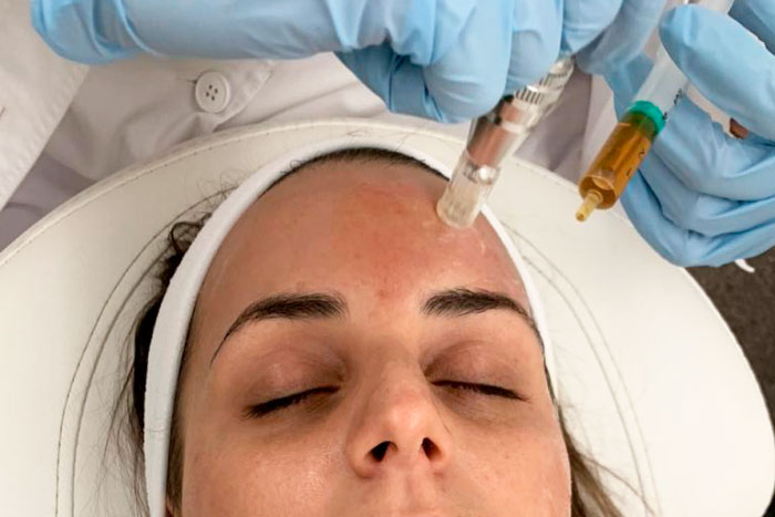 Tratamiento estético oculofacial con colagenoterapia y microneedling