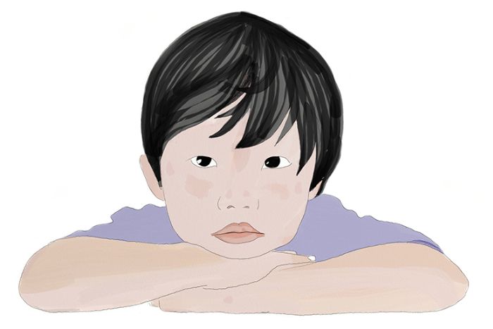 Estrabismo en la infancia