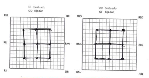 Recuperación de la visión binocular