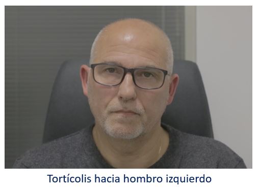 Recuperación de la visión binocular en paciente con diplopia